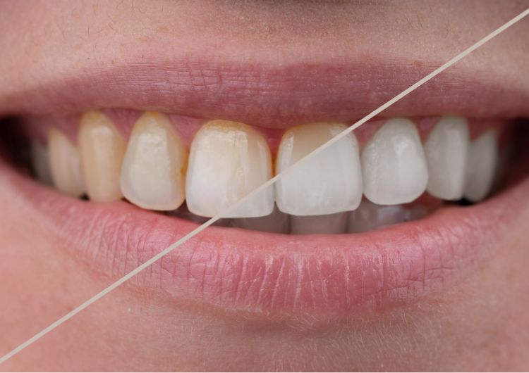 ホワイトニングのビフォーアフター